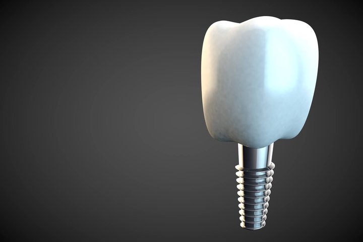 a single dental implant in Winter Park, FL