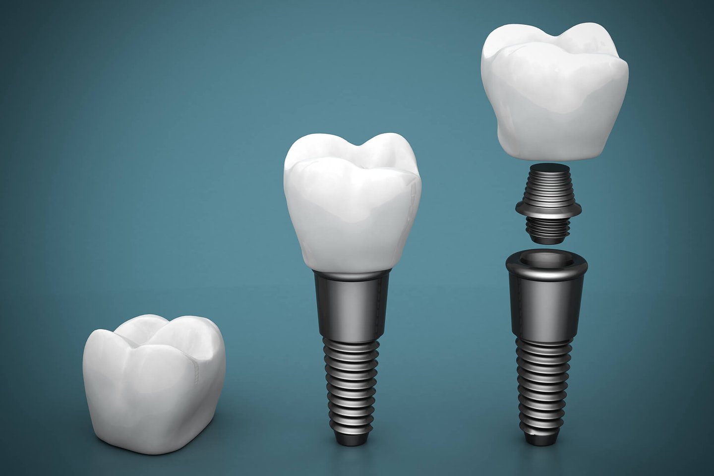 structure of dental implants in winter park fl