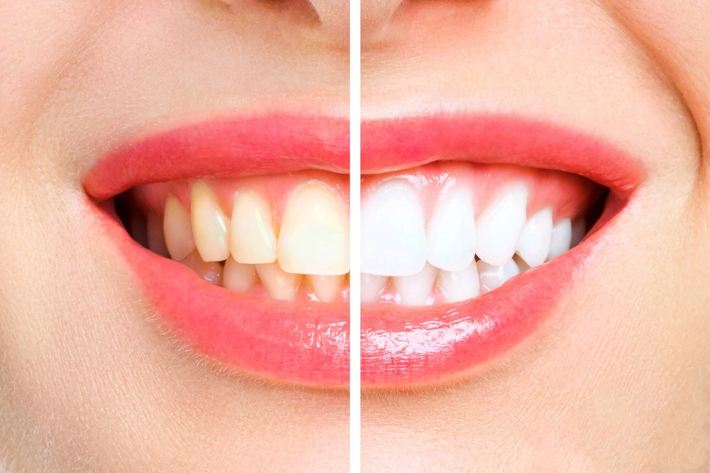 Veneers vs Teeth Whitening: Which Is Better?