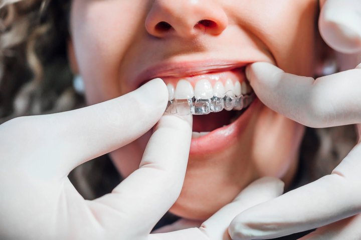 patient fitting her new winter park fl invisalign