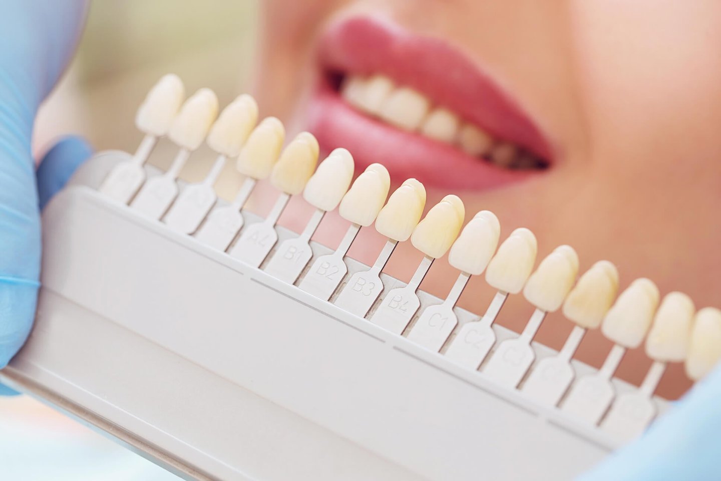 Who Needs Dental Crowns in Winter Park?