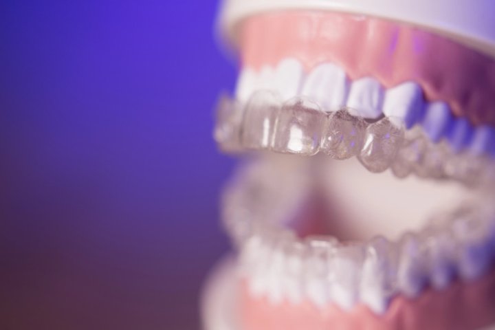 denture with invisalign winter park