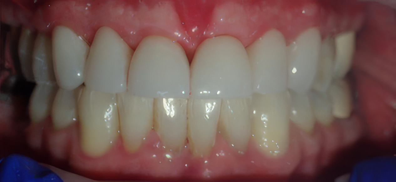 Full smile after implant restoration