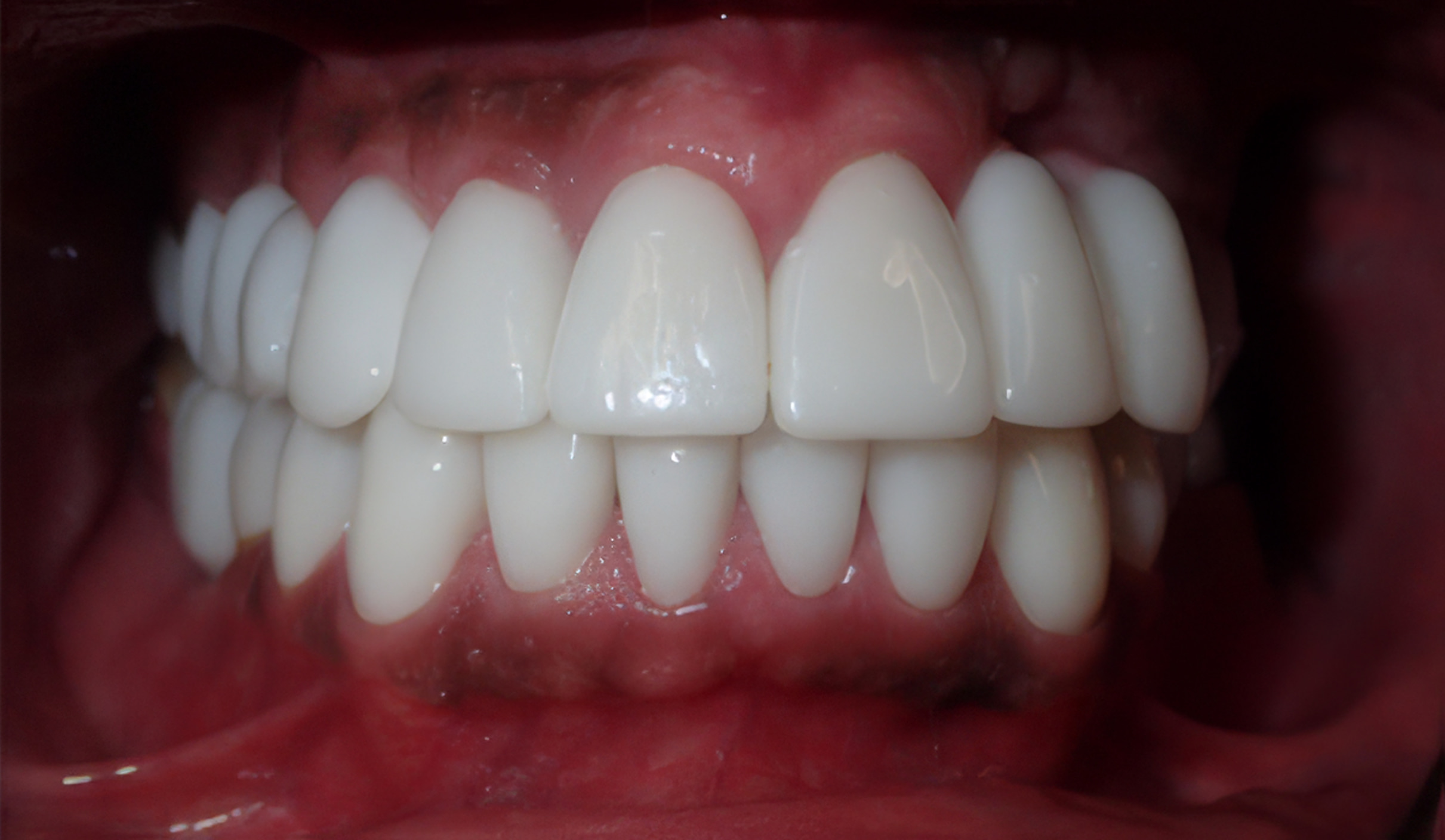 Brighter, even smile after porcelain veneers