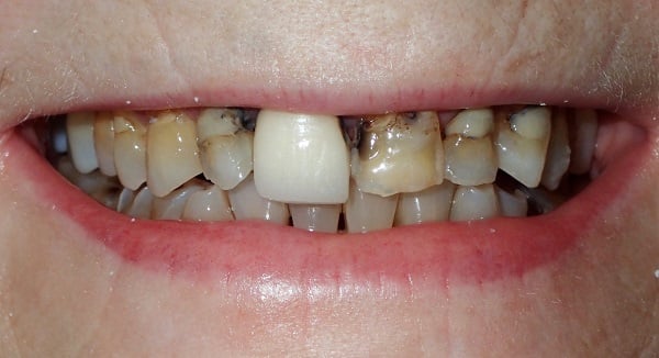 Smile before restoration