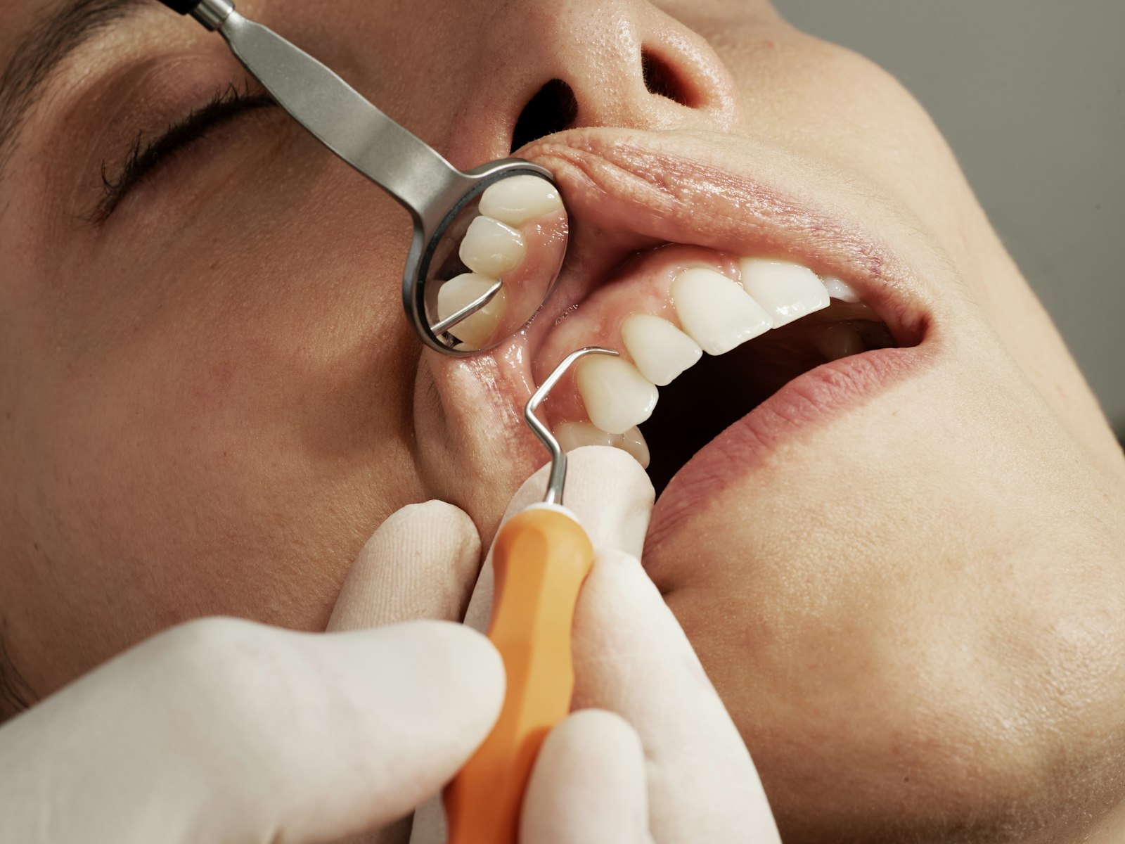 Root Canals