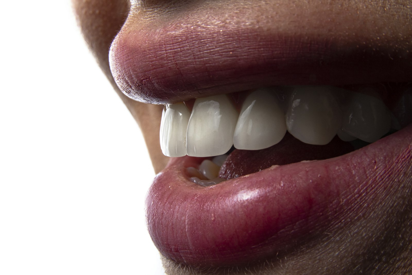 Porcelain Veneers