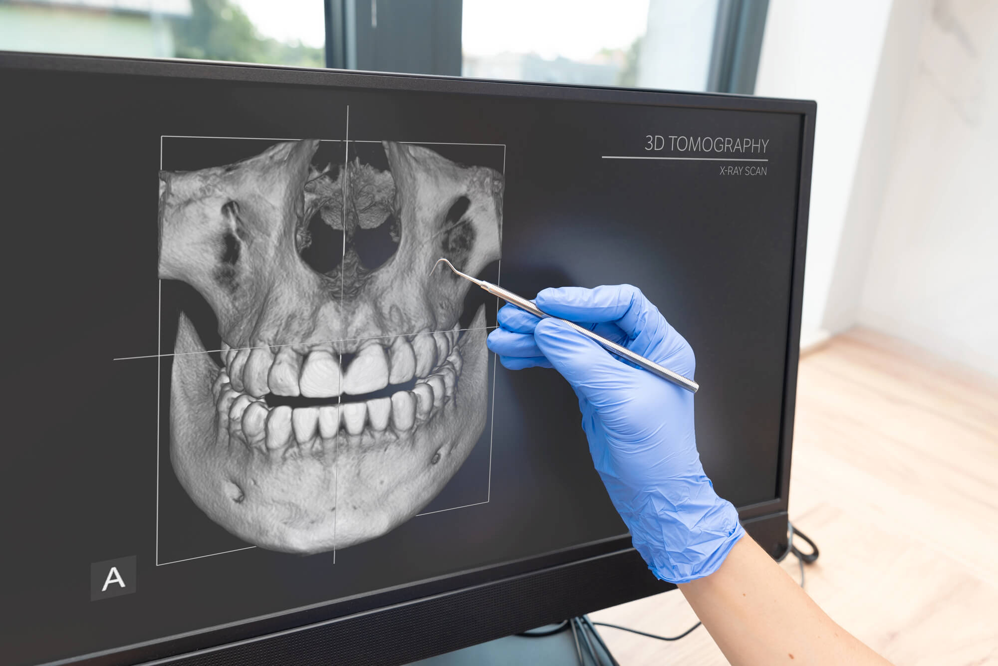 How-Dental-Implants-in-Winter-Park-FL-Improve-Bone-Health