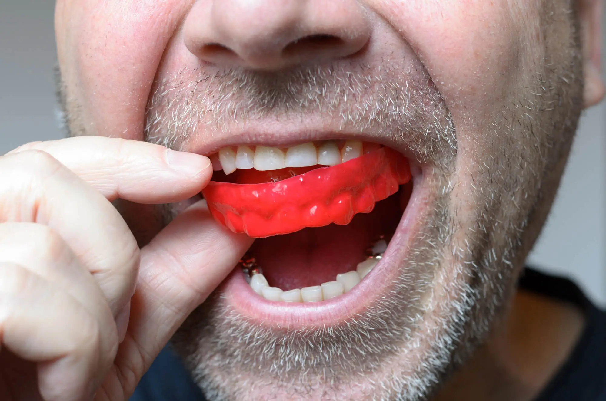 Cosmetic Dentist in Winter Park Explains How to Protect Your Veneers form Bruxism
