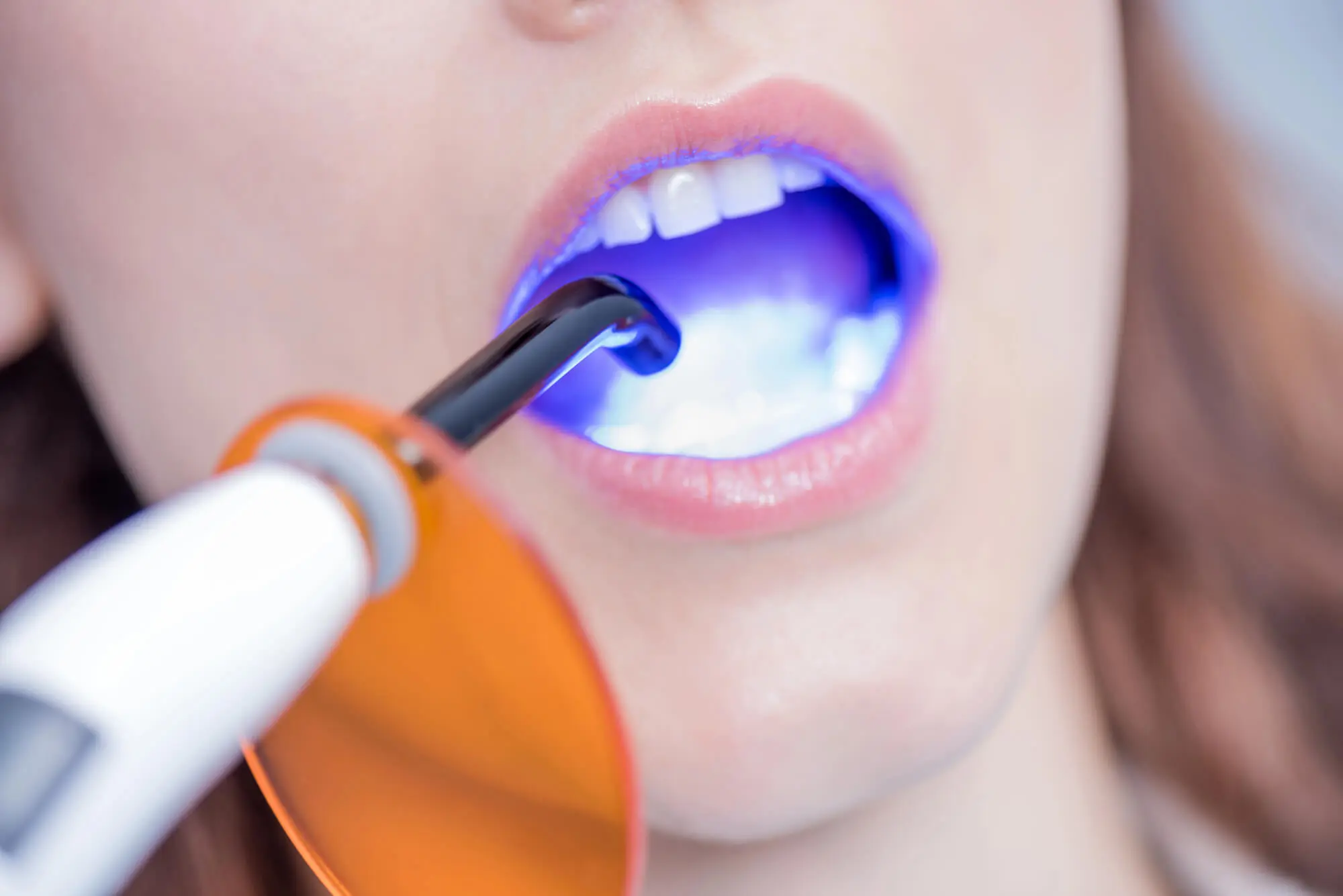 Park Dental Teeth Whitening