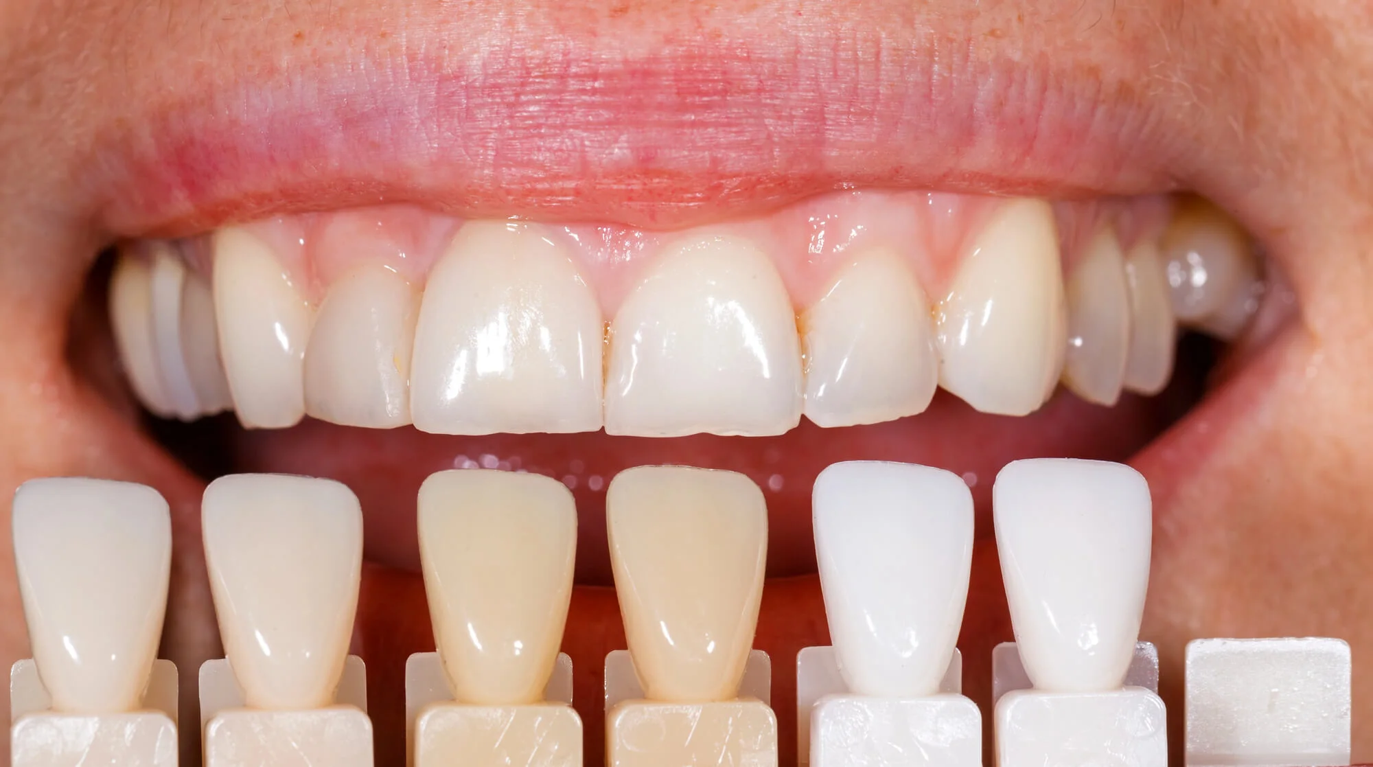 Tooth shade guide for veneers, veneers in Winter Park