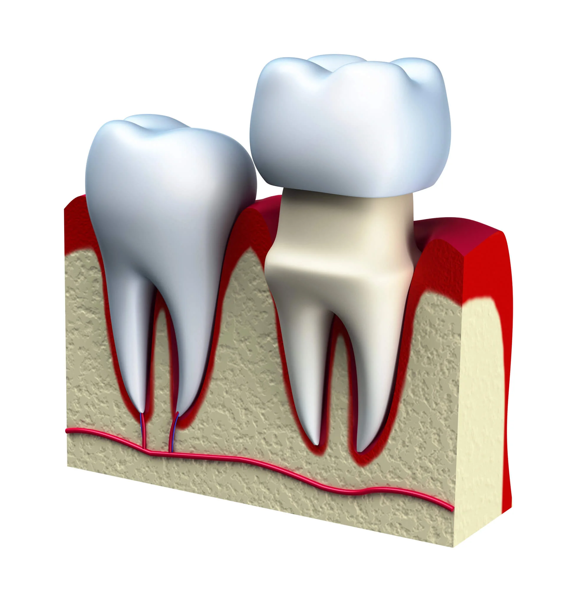 Dental implant illustration replacing damaged tooth dental implants in Orlando, FL