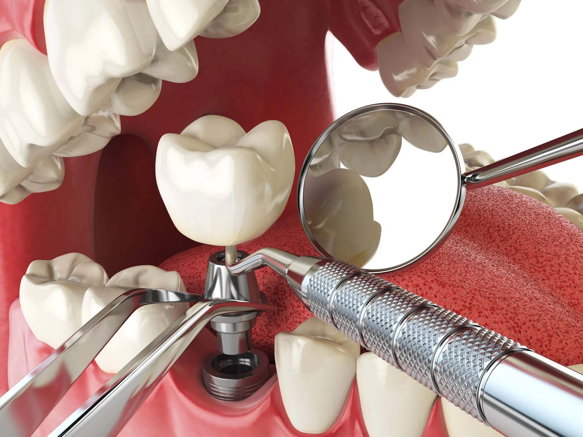 Dental implant placement close-up with tools dental implants in Winter Park, FL