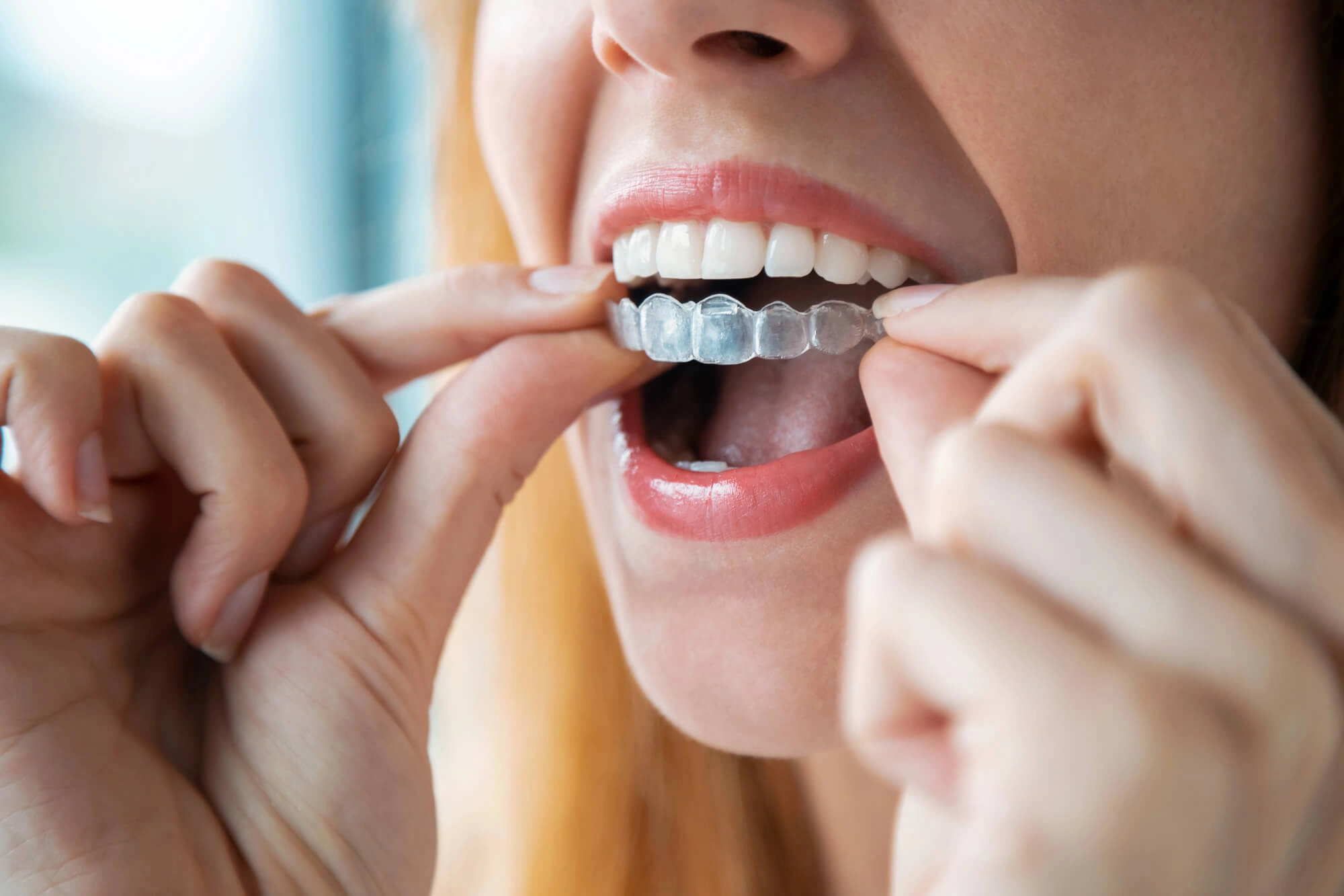 Girl-ready-to-wear-her-invisalign-winter-park