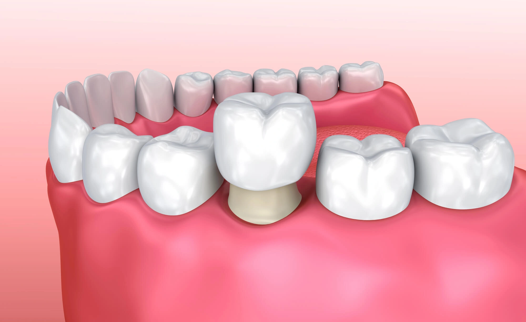 Crowns-or-best-veneers-in-orlando