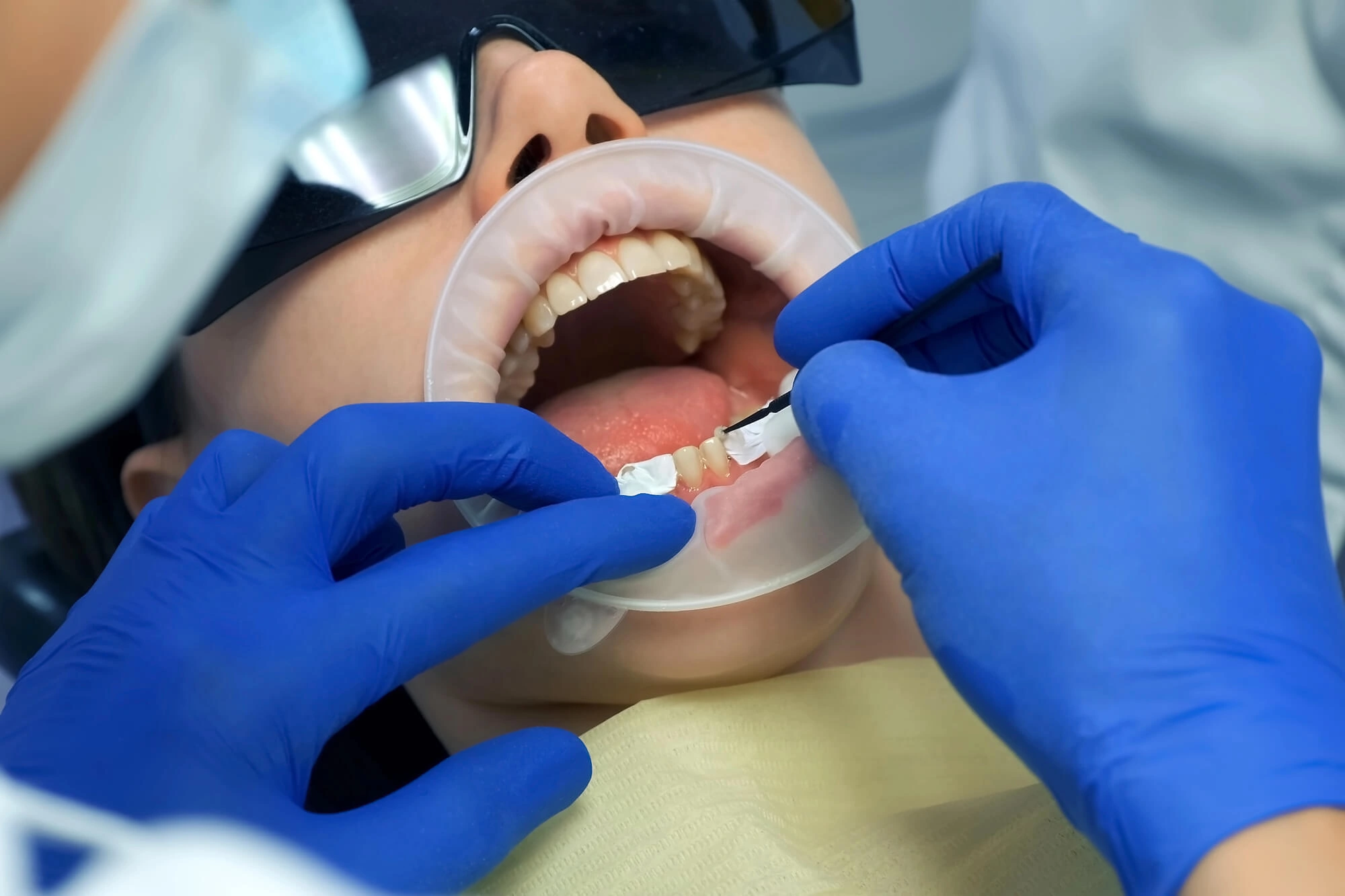 Woman-undergoing-best-veneers-in-orlando