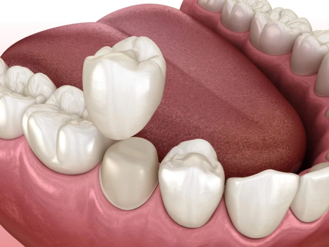 Can a Crowned Tooth Still Get Cavities? What You Need to Know