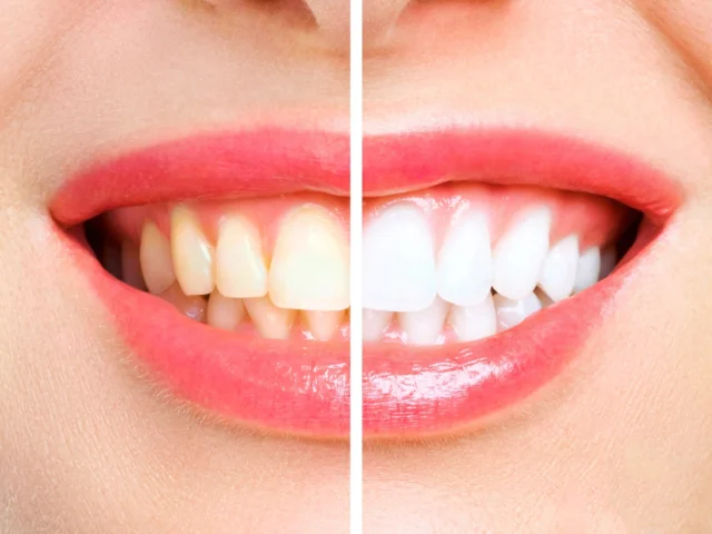 Veneers vs Teeth Whitening: Which Is Better?
