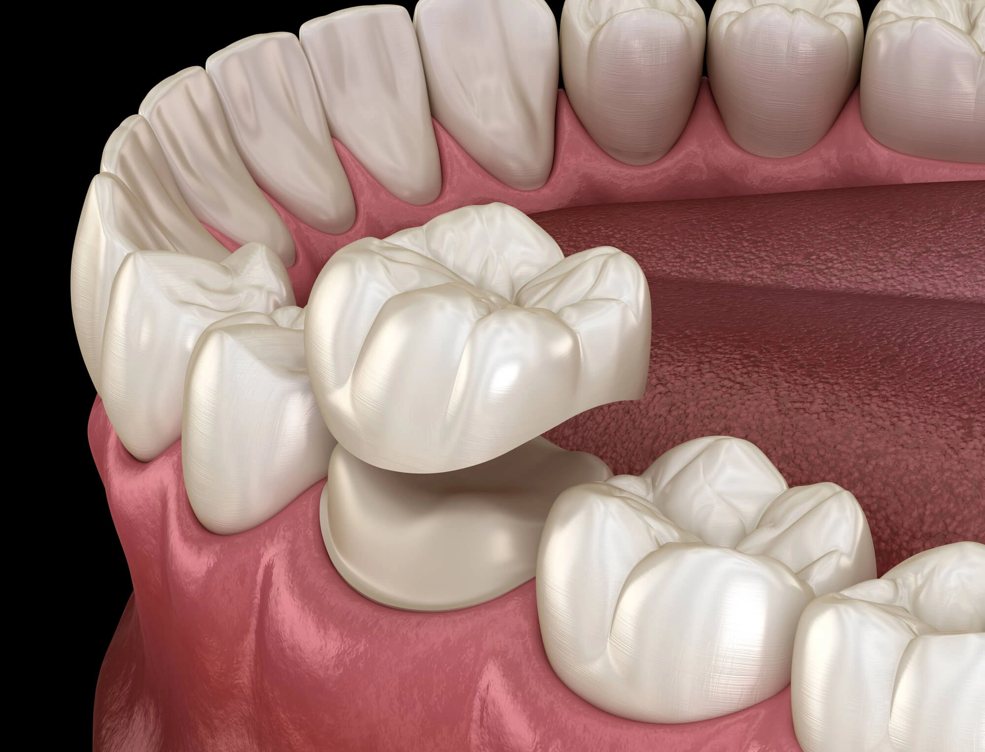 3D Illustration of dental crowns winter park