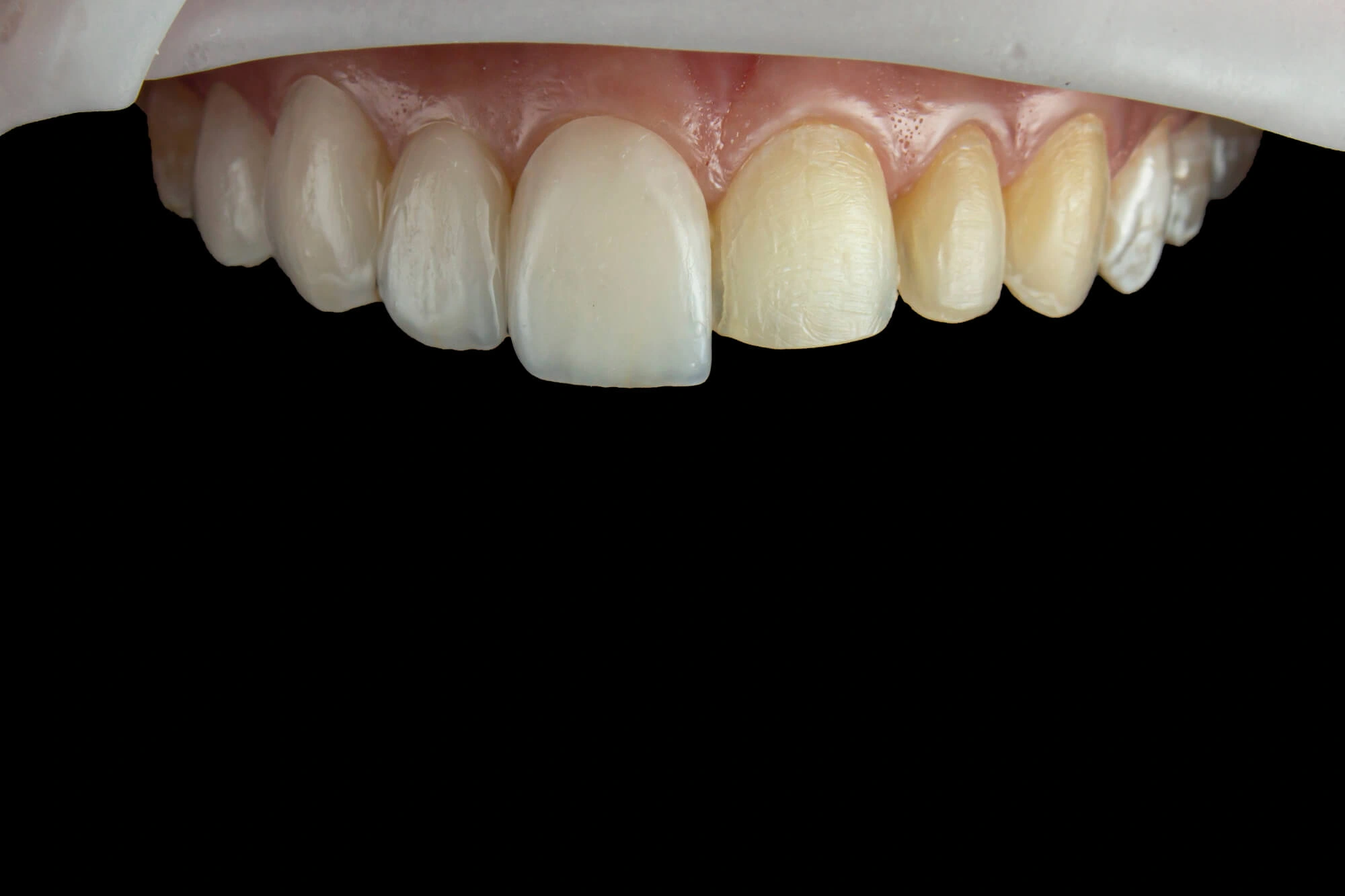 veneers winter park