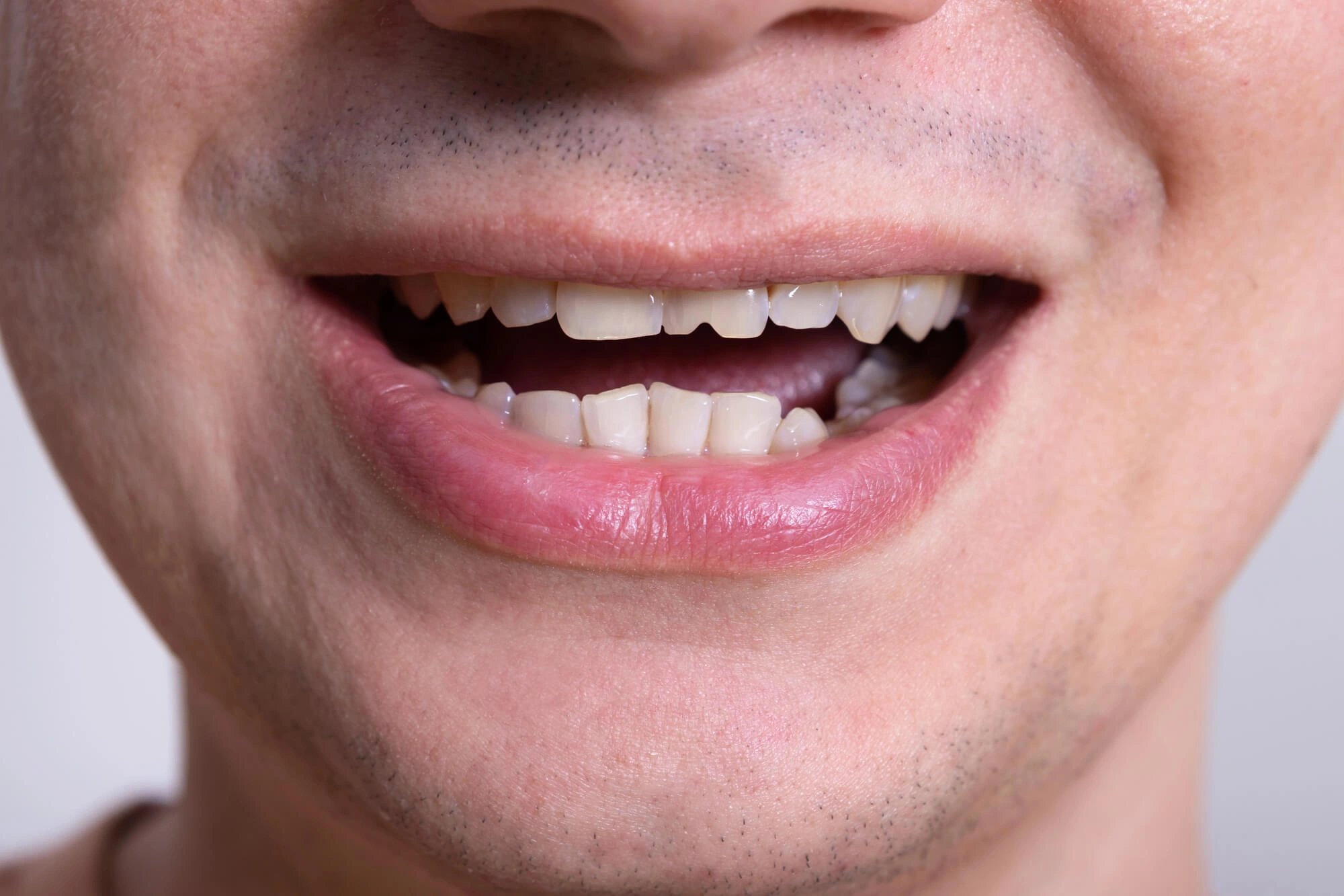 Damaged teeth needs Dentist 32792