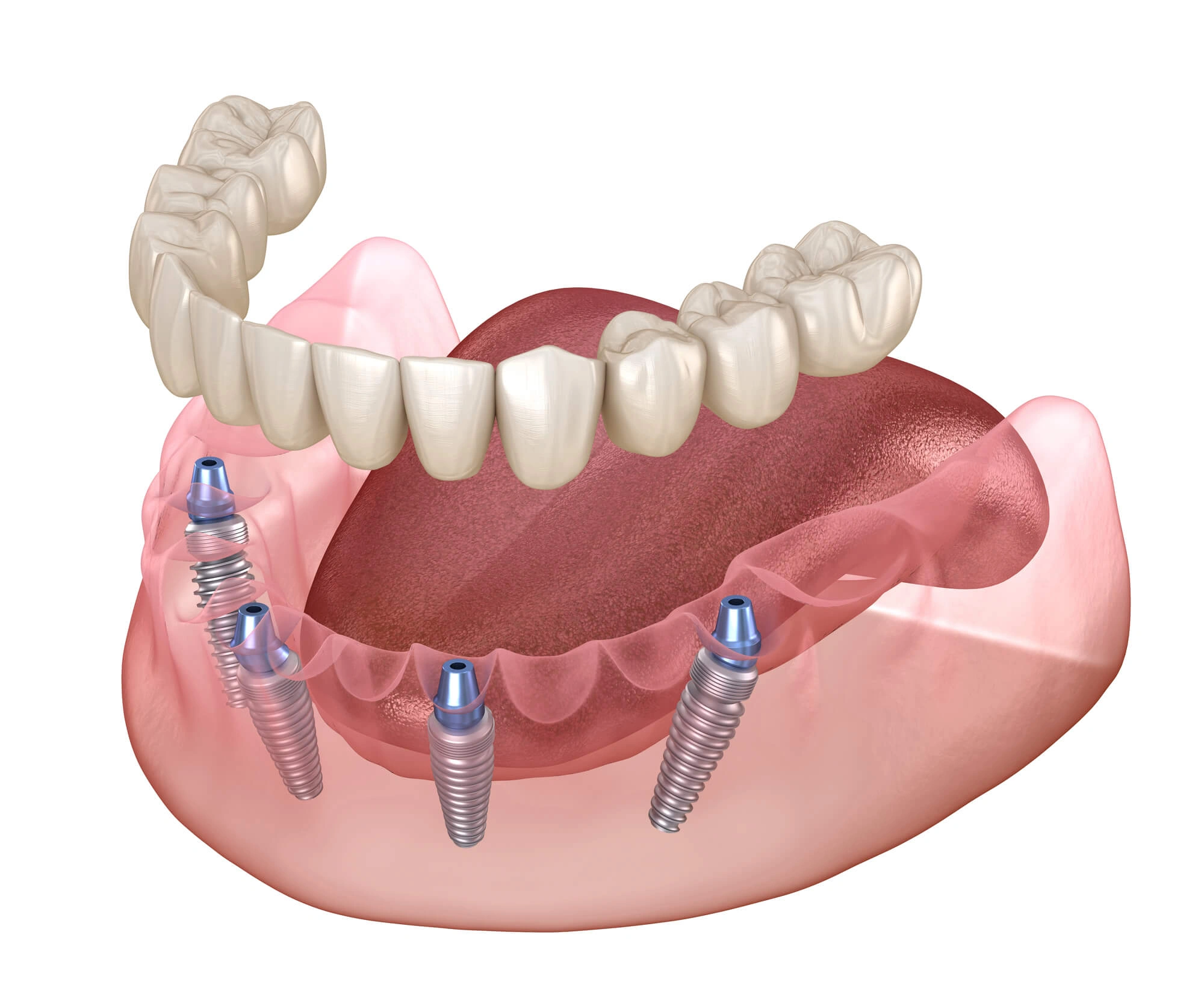 Illustration of all-on-4 dental implants Winter Park  fl