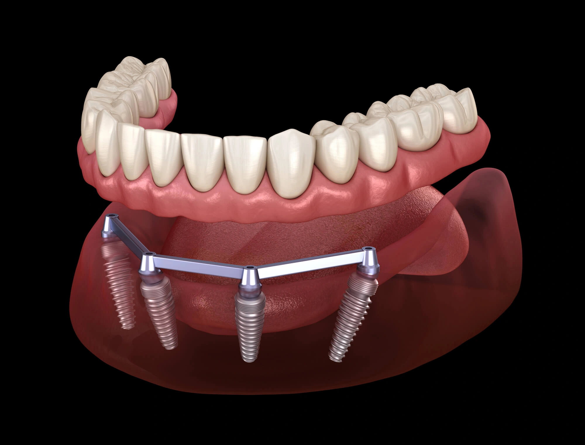 all-on-4 dental implants Winter Park  fl